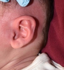 Ear Surgery After Photo by Rachel Ruotolo, MD; Garden City, NY - Case 41379