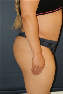 Buttock Lift with Augmentation After Photo by Steve Laverson, MD, FACS; Rancho Santa Fe, CA - Case 41462