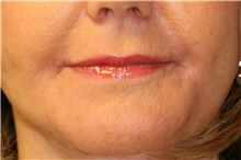 Lip Augmentation/Enhancement After Photo by Steve Laverson, MD, FACS; Rancho Santa Fe, CA - Case 41607