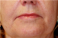 Lip Augmentation/Enhancement Before Photo by Steve Laverson, MD, FACS; Rancho Santa Fe, CA - Case 41607