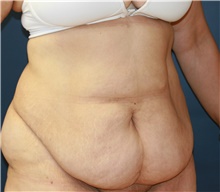 Tummy Tuck Before Photo by Steve Laverson, MD, FACS; Rancho Santa Fe, CA - Case 41702