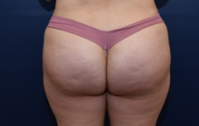 Buttock Lift with Augmentation After Photo by Michael Dobryansky, MD, FACS; Garden City, NY - Case 41747