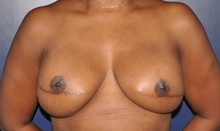 Breast Reconstruction After Photo by Jerry Weiger Chang, MD, FACS; Flushing, NY - Case 41850