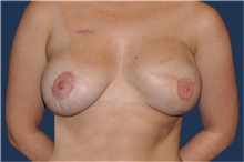 Breast Reconstruction After Photo by Jerry Weiger Chang, MD, FACS; Flushing, NY - Case 41852