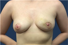 Breast Reconstruction Before Photo by Jerry Weiger Chang, MD, FACS; Flushing, NY - Case 41852