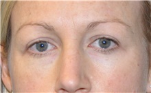 Eyelid Surgery After Photo by Joshua Cooper, MD; Seattle, WA - Case 41867