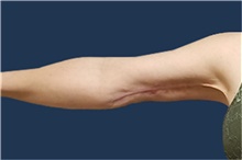 Arm Lift After Photo by Noel Natoli, MD, FACS; East Hills, NY - Case 41903