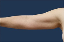 Arm Lift Before Photo by Noel Natoli, MD, FACS; East Hills, NY - Case 41903