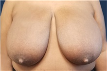 Breast Reduction Before Photo by Noel Natoli, MD, FACS; East Hills, NY - Case 41915