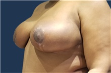 Breast Reduction After Photo by Noel Natoli, MD, FACS; East Hills, NY - Case 41915