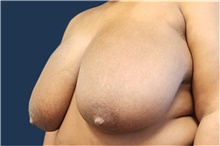 Breast Reduction Before Photo by Noel Natoli, MD, FACS; East Hills, NY - Case 41915