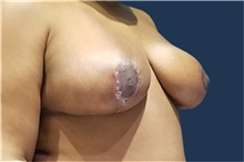 Breast Reduction After Photo by Noel Natoli, MD, FACS; East Hills, NY - Case 41915