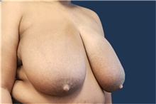 Breast Reduction Before Photo by Noel Natoli, MD, FACS; East Hills, NY - Case 41915