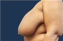 Breast Reduction Before Photo by Noel Natoli, MD, FACS; East Hills, NY - Case 41915