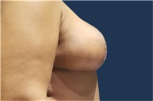 Breast Reduction After Photo by Noel Natoli, MD, FACS; East Hills, NY - Case 41915