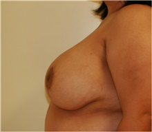 Breast Reduction After Photo by Steve Laverson, MD, FACS; Rancho Santa Fe, CA - Case 41936