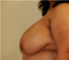 Breast Reduction Before Photo by Steve Laverson, MD, FACS; Rancho Santa Fe, CA - Case 41936