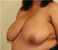 Breast Reduction Before Photo by Steve Laverson, MD, FACS; Rancho Santa Fe, CA - Case 41936