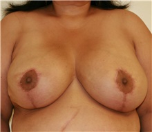 Breast Reduction After Photo by Steve Laverson, MD, FACS; Rancho Santa Fe, CA - Case 41936