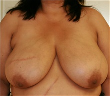 Breast Reduction Before Photo by Steve Laverson, MD, FACS; Rancho Santa Fe, CA - Case 41936