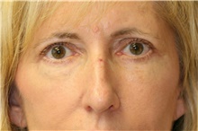 Eyelid Surgery After Photo by Steve Laverson, MD, FACS; Rancho Santa Fe, CA - Case 41979