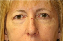 Eyelid Surgery Before Photo by Steve Laverson, MD, FACS; Rancho Santa Fe, CA - Case 41979