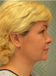 Chin Augmentation After Photo by Mark McRae, MD, FRCS(C); Burlington, ON - Case 42014