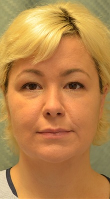 Chin Augmentation After Photo by Mark McRae, MD, FRCS(C); Burlington, ON - Case 42014