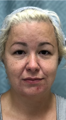 Chin Augmentation Before Photo by Mark McRae, MD, FRCS(C); Burlington, ON - Case 42014