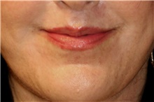 Lip Augmentation/Enhancement After Photo by Steve Laverson, MD, FACS; Rancho Santa Fe, CA - Case 42110