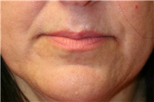 Lip Augmentation/Enhancement Before Photo by Steve Laverson, MD, FACS; Rancho Santa Fe, CA - Case 42110