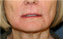 Lip Augmentation/Enhancement After Photo by Steve Laverson, MD, FACS; Rancho Santa Fe, CA - Case 42129