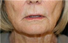 Lip Augmentation/Enhancement Before Photo by Steve Laverson, MD, FACS; Rancho Santa Fe, CA - Case 42129