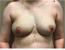 Breast Reconstruction After Photo by Nicholas Leonardi, DO; Germantown, TN - Case 42436