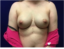 Breast Reconstruction Before Photo by Nicholas Leonardi, DO; Germantown, TN - Case 42436