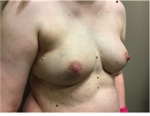 Breast Reconstruction After Photo by Nicholas Leonardi, DO; Germantown, TN - Case 42436