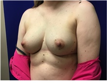 Breast Reconstruction Before Photo by Nicholas Leonardi, DO; Germantown, TN - Case 42436