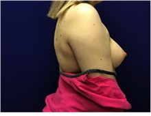 Breast Reconstruction Before Photo by Nicholas Leonardi, DO; Germantown, TN - Case 42436