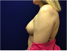 Breast Reconstruction Before Photo by Nicholas Leonardi, DO; Germantown, TN - Case 42436