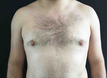 Male Breast Reduction After Photo by Sean Doherty, MD; Brookline, MA - Case 42762