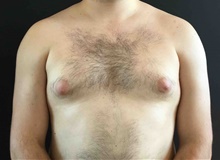 Male Breast Reduction Before Photo by Sean Doherty, MD; Brookline, MA - Case 42762