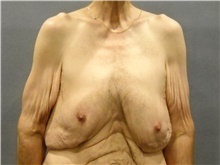 Male Breast Reduction Before Photo by Ellen Janetzke, MD; Bloomfield Hills, MI - Case 42994