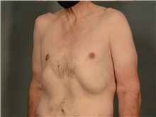 Male Breast Reduction After Photo by Ellen Janetzke, MD; Bloomfield Hills, MI - Case 42994