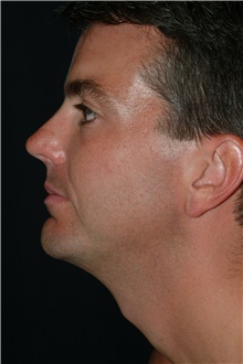 Chin Augmentation After Photo by Brian Hass, MD; Palm Beach Gardens, FL - Case 43000