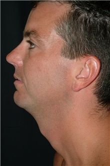 Chin Augmentation Before Photo by Brian Hass, MD; Palm Beach Gardens, FL - Case 43000