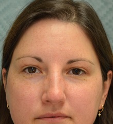 Eyelid Surgery After Photo by Mark McRae, MD, FRCS(C); Burlington, ON - Case 43124