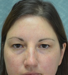 Eyelid Surgery Before Photo by Mark McRae, MD, FRCS(C); Burlington, ON - Case 43124