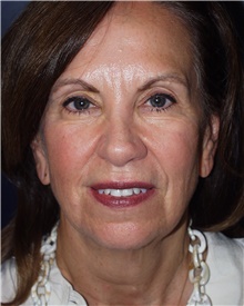 Facelift Before Photo by Barry Douglas, MD, FACS; Garden City, NY - Case 43293