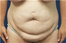 Tummy Tuck Before Photo by Noel Natoli, MD, FACS; East Hills, NY - Case 43339