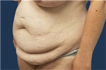 Tummy Tuck Before Photo by Noel Natoli, MD, FACS; East Hills, NY - Case 43339